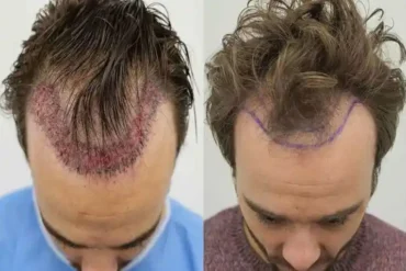 About General Information Is Hair Transplant Permanent