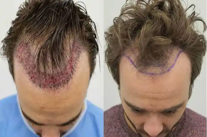 About General Information Is Hair Transplant Permanent