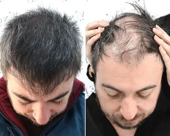 Hair transplant treatment