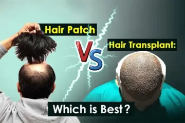 Complete Info Hair Transplant vs Hair Patch Which Is Better